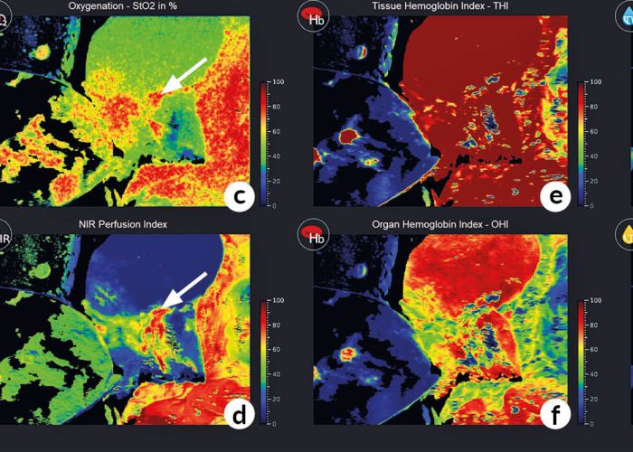 Hyperspektral-Imaging zeigt Gewebeperfusion, Sauerstoffsättigung und Hämoglobinindex im OP